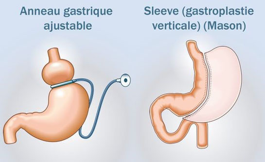 techniques chirurgicales anneau gastrique chirurgie de l'obésité hôpital de Narbonne