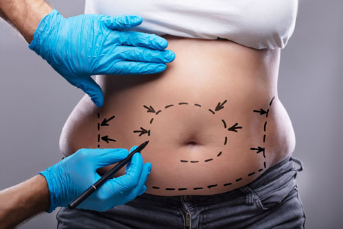 chirurgie de l'obésité techniques hopital narbonne